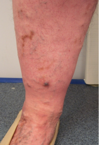 72 year old woman with recent rupture and bleeding on her leg.