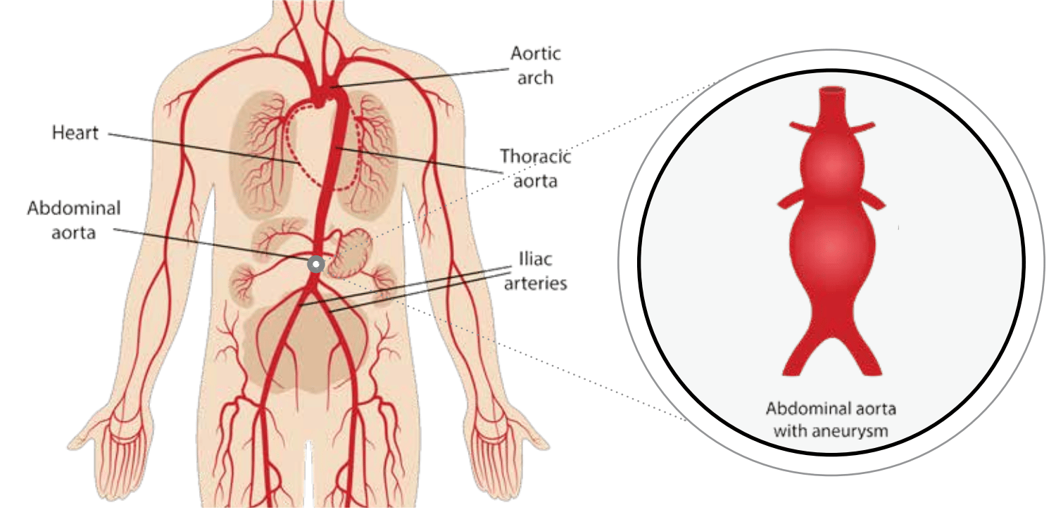 Understanding Abdominal Aortic Aneursyms