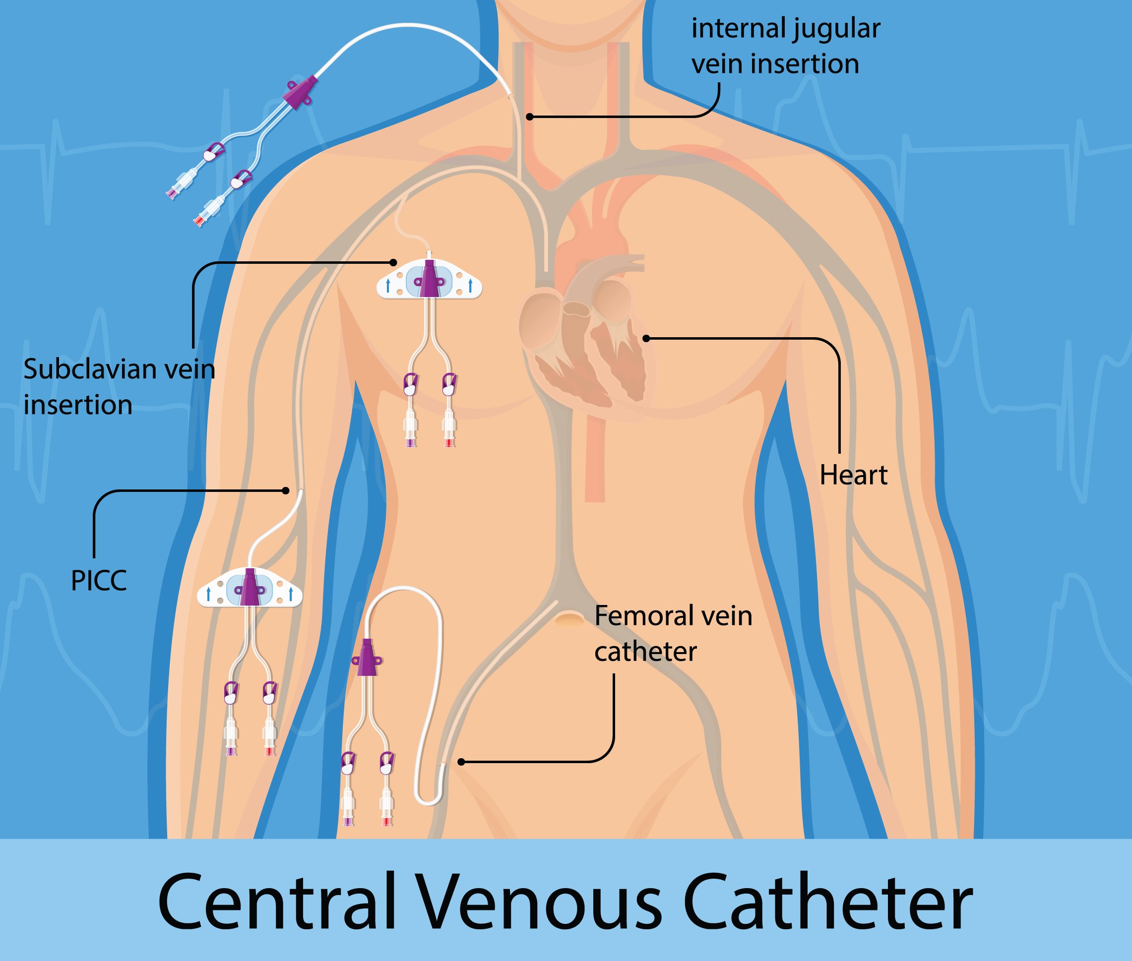 What Are Central Venous Catheters?