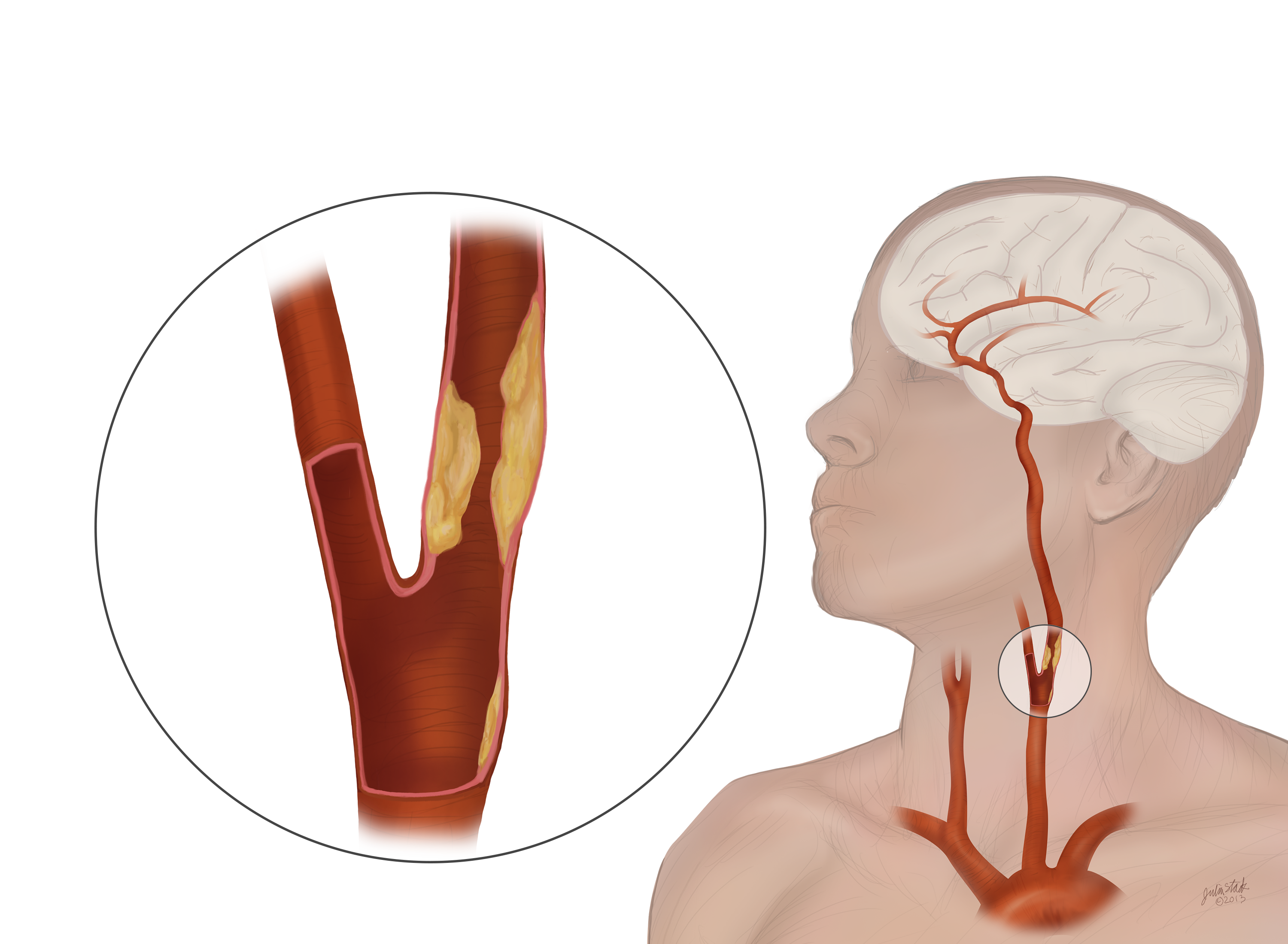 TCAR – The Future of Carotid Repair