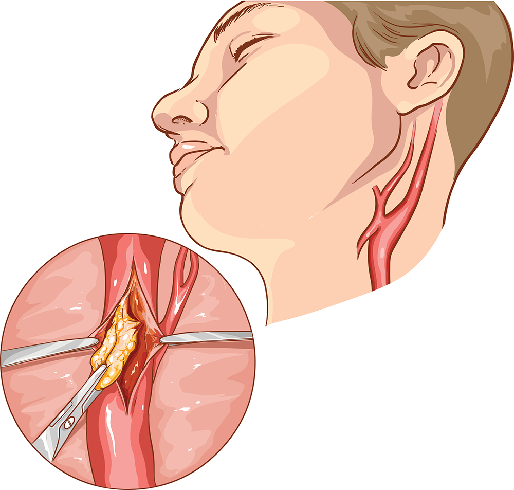 What is a Carotid Endarterectomy