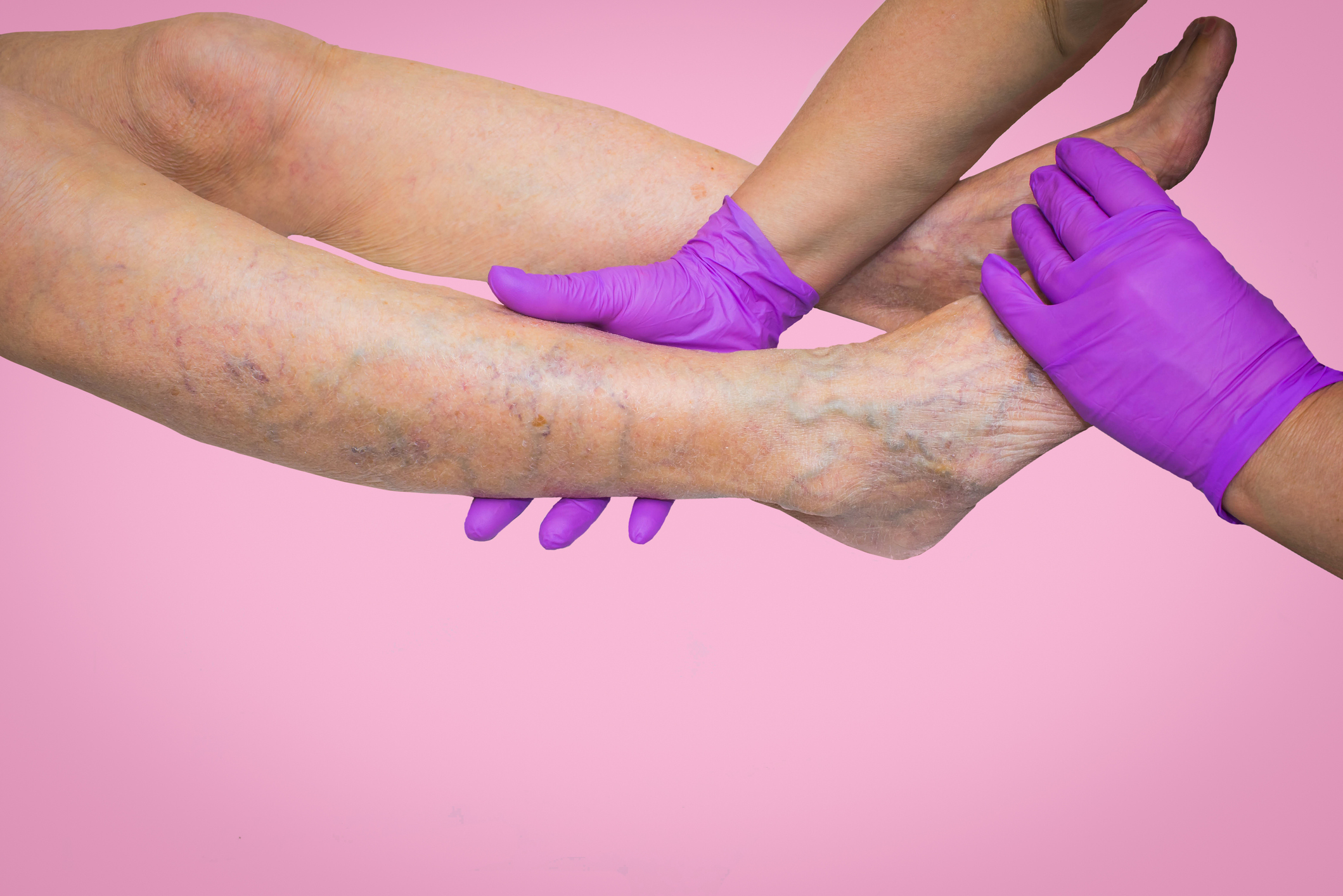 What is Chronic Venous Insufficiency?