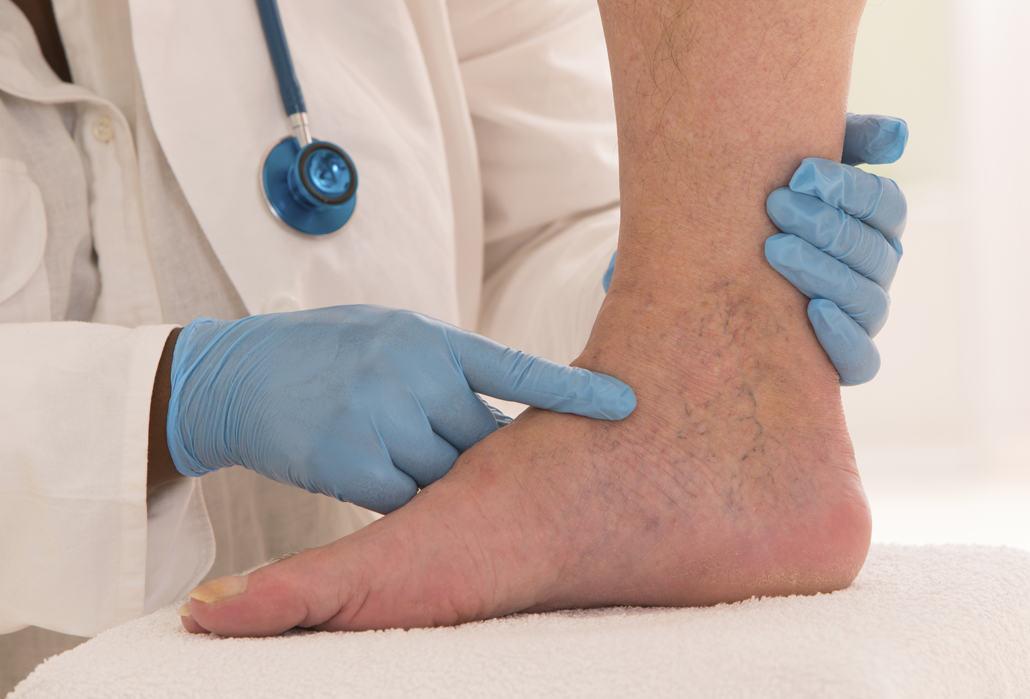 Cosmetic and Medical Symptoms of Spider Veins