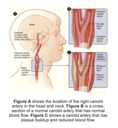 Carotid Artery Disease The Cardio Vascular Care Group