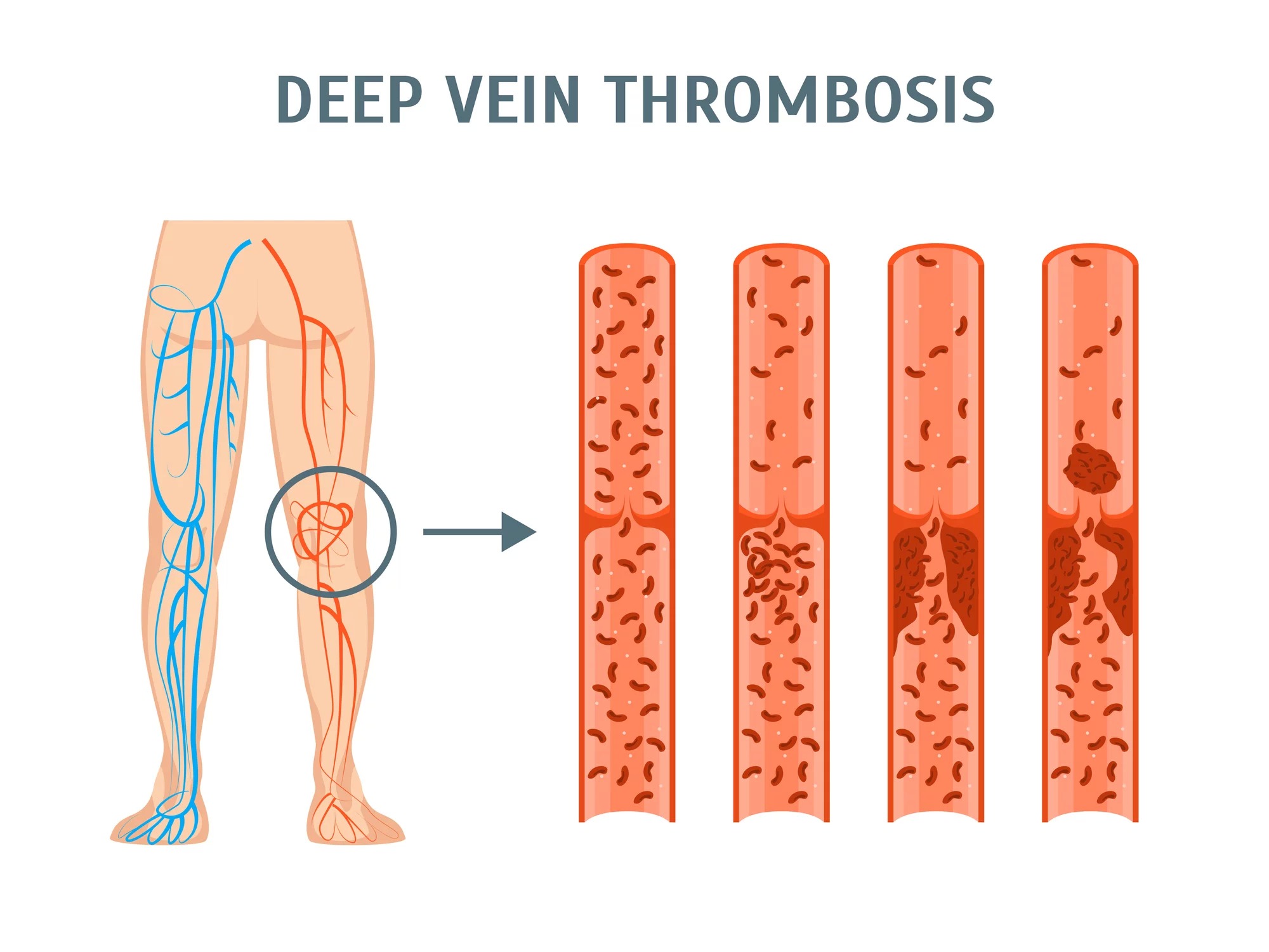 Deep Vein Thrombosis (DVT) – Awareness Matters