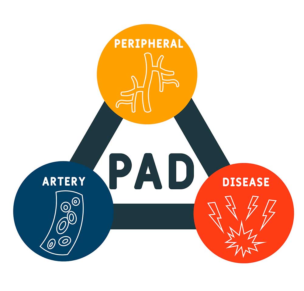 Surgical Options for Treating Peripheral Arterial Disease