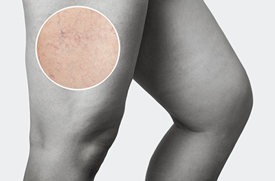 9 Common FAQs for Spider Veins and Sclerotherapy