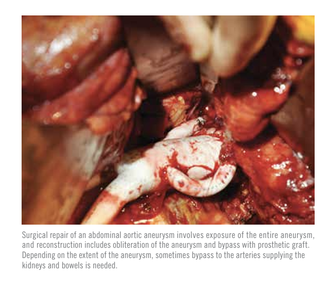 Surgical Considerations for Aortic Aneurysms