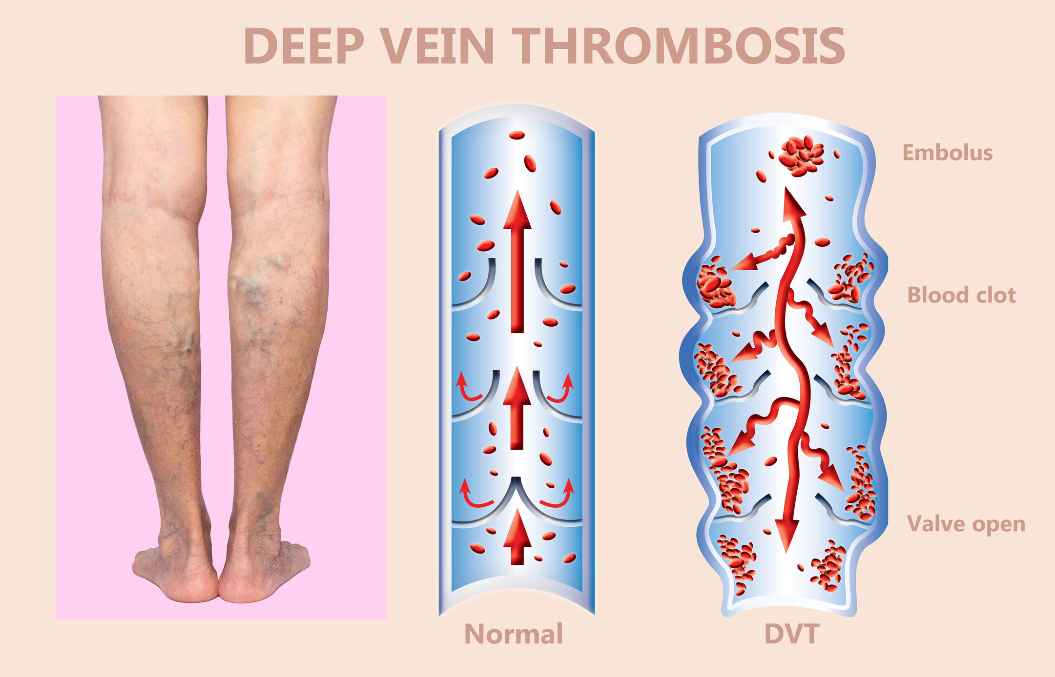 March is Deep Vein Thrombosis Awareness Month - FAQs on DVT