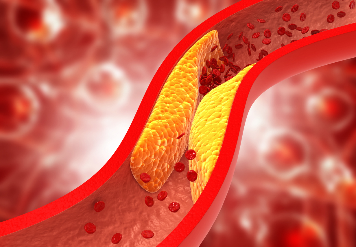 Can Medicines Clear Blocked Arteries? What Patients Should Know
