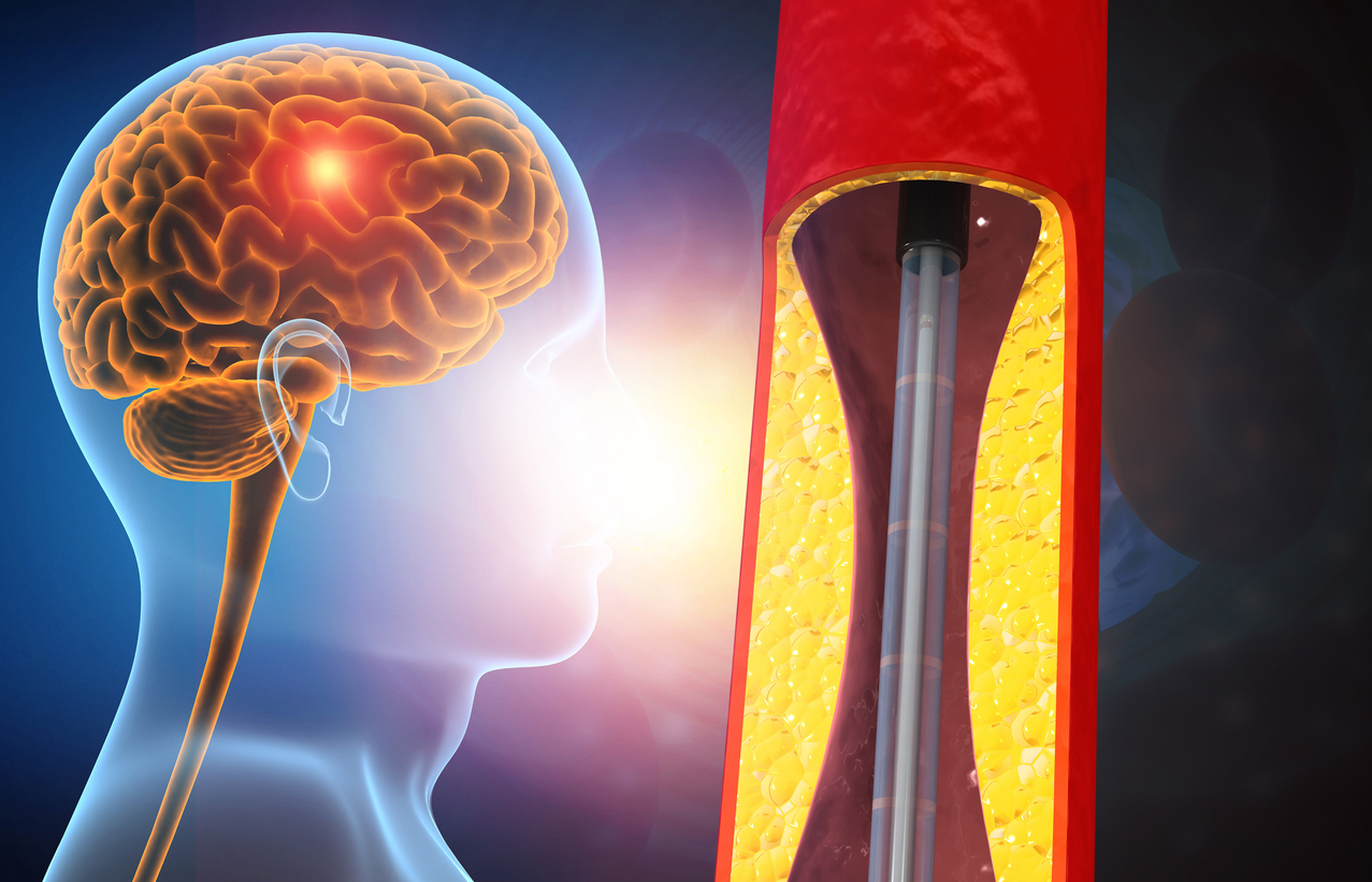 Latest Treatment Options for Carotid Artery Disease