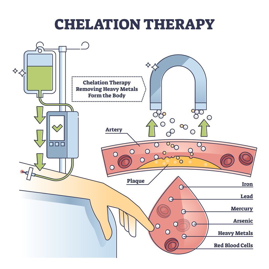 Does Chelation Therapy Work to Get Rid of the Plaque in My Arteries?