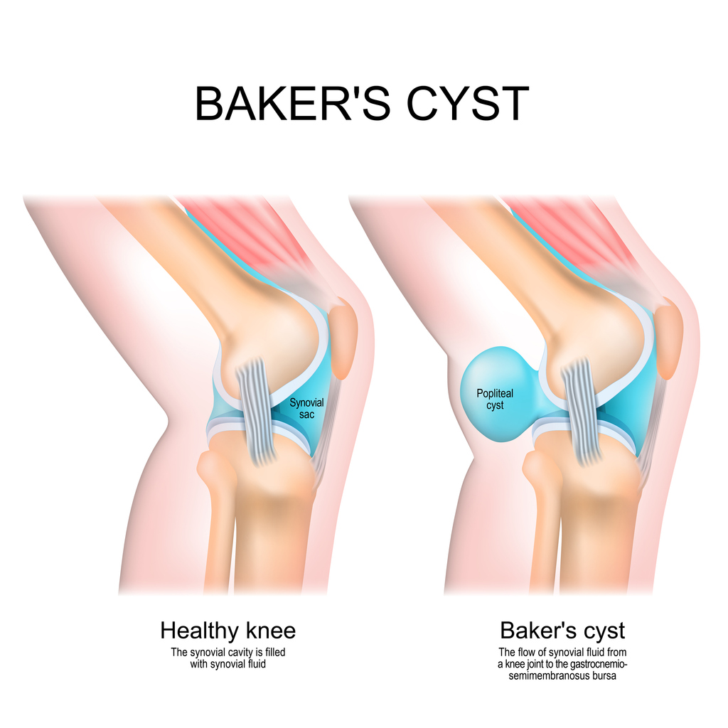 Does a Baker's Cyst Mean I Have Vein Issues?
