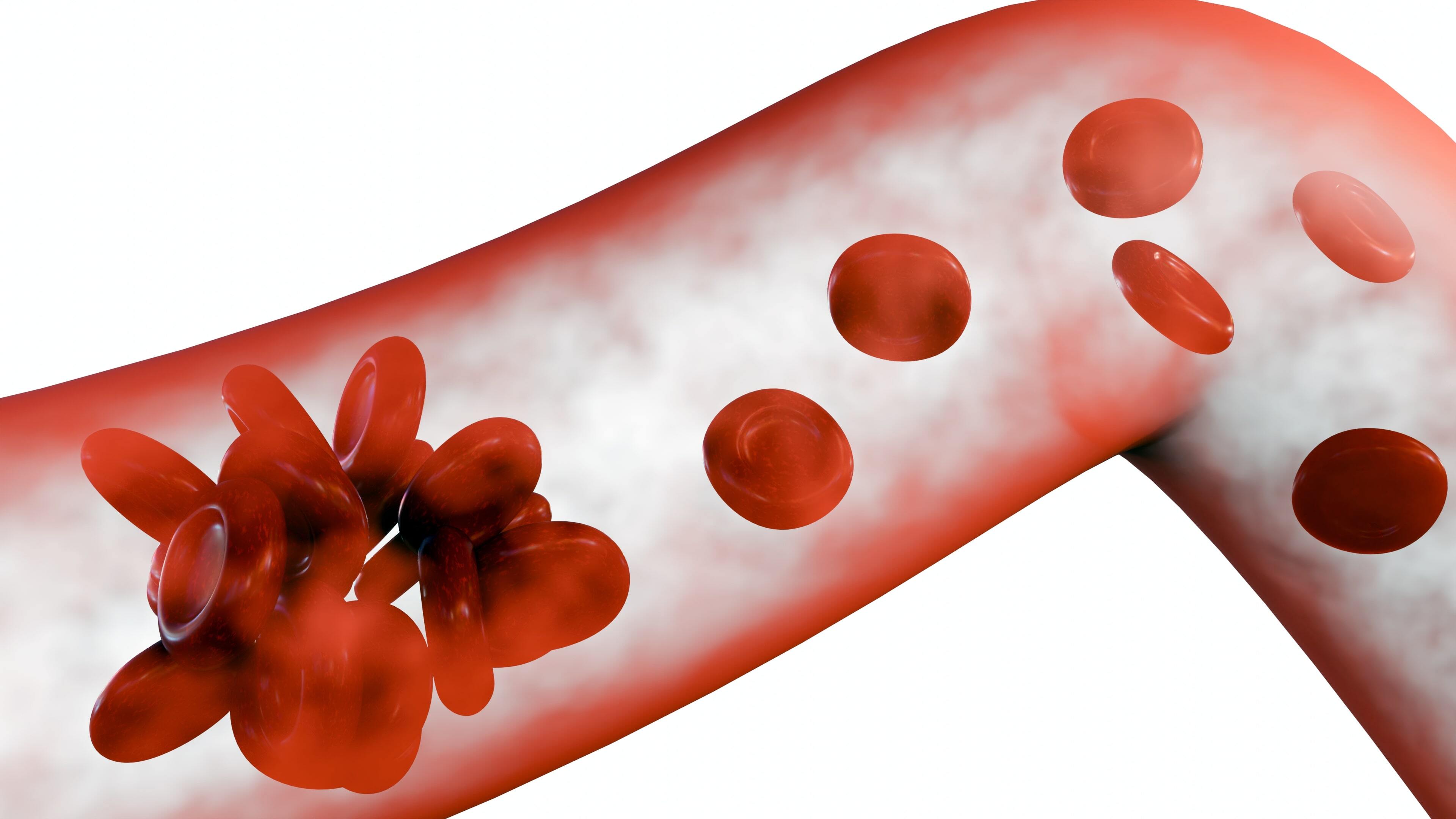Do Blood Thinners Prevent Narrowing of the Arteries?