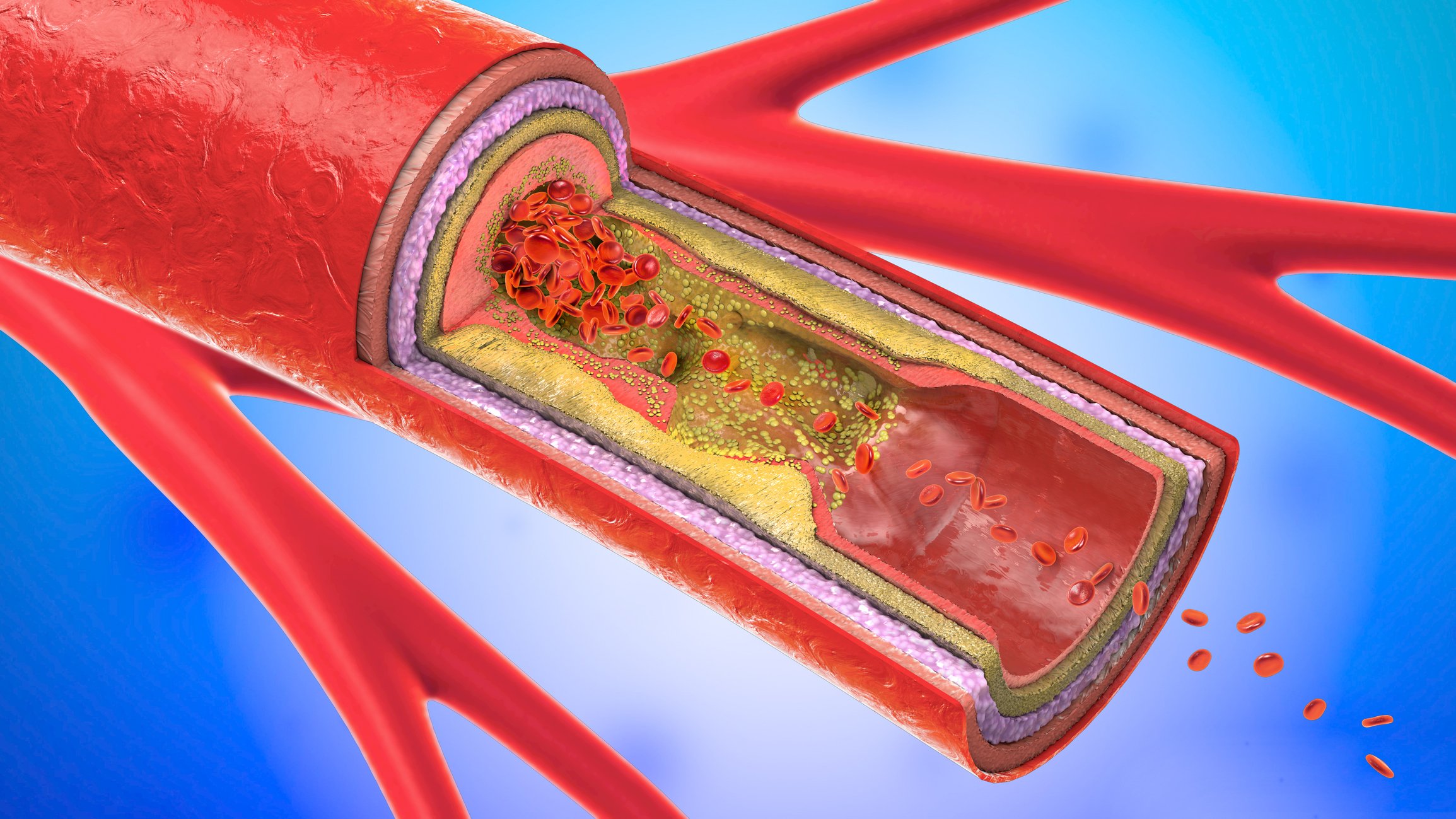 How to Keep Your Carotid Arteries Healthy